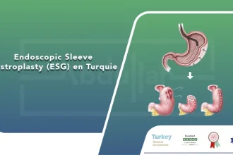 Endoscopic Sleeve Gastroplasty (ESG) en Turquie