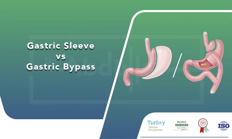 Gastric Sleeve vs Gastric Bypass