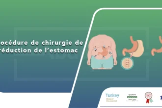 Procédure de chirurgie de réduction de l’estomac